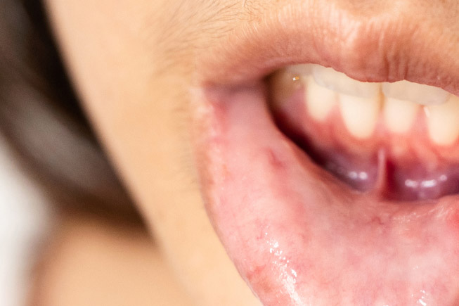 Eine Person zieht ihre Unterlippe herunter und legt ihr Lippenbändchen frei.